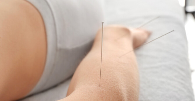 Acupuncture