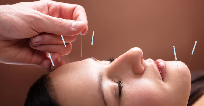 Acupuncture